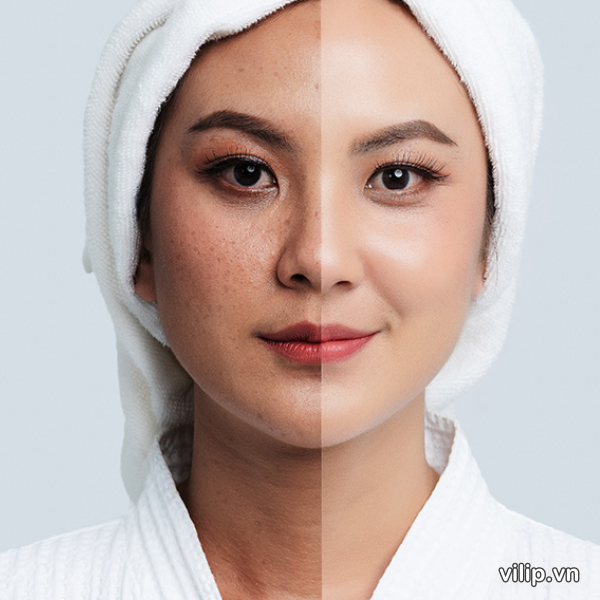 Kem Dac Tri Nam Tan Nhang Doi Moi Zo Skin Health Pigment Control Cream 4 Hq 7